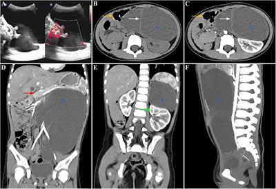 Retroperitoneal neuroglial heterotopia: a case report and literature review